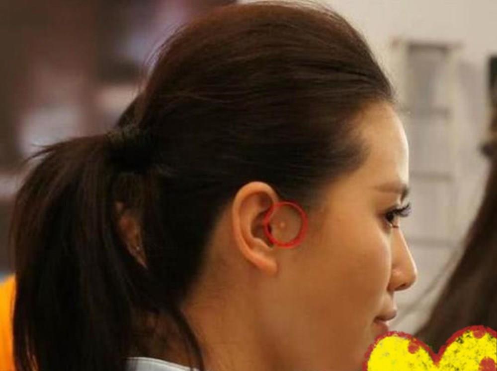 耳边多“肉揪”,孩子理发被嘲笑,耳有“拴马桩”是福气的象征?