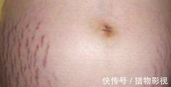 孕期|这几类幸运孕妈最不容易长妊娠纹?医生直言:确实如此