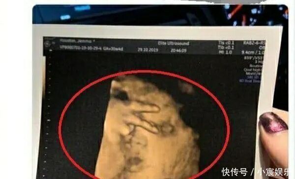 彩超|迫不及待想看孩子,四维彩超时宝宝却比个“v”,医生忍不住笑了