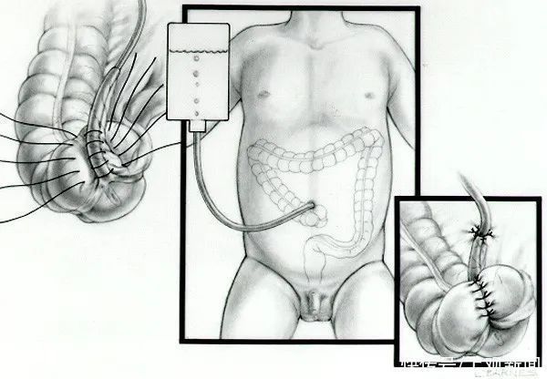 患儿|7岁男孩便便不受控，无法上学！马龙手术来解决，没有阑尾，还可造个