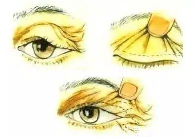 重睑 什么是割双眼皮呢?割双眼皮手术都包含哪些项目?你都了解吗