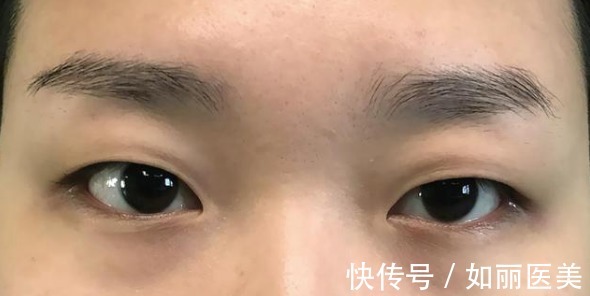 切口 双眼皮越宽眼睛就越大吗?医生揭开双眼皮手术的5个“真相”!