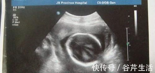 肾盂分离|通过产检B超单的“肾盂分离”,可判断胎儿性别还真有一定道理