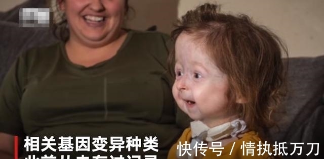 伊利斯|2岁女童看起来像80岁,病情独特全球首例,网友:希望返老还童