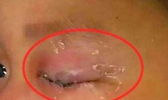 为人父母|3岁女宝误将502滴入眼睛,宝妈临危不乱的做法,获医生夸赞