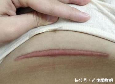 剖腹產|同樣是“一刀”,側切和剖腹產區別有多大?這7大區別你未必想得到