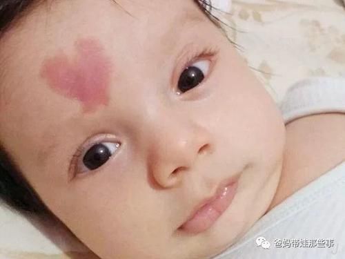 宝宝额头长“胎记”，竟是血管瘤，孕妈妈怎样预防？