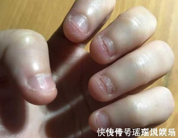 甲沟炎|研究发现:爱咬指甲的孩子,都逃不过这5种结局!