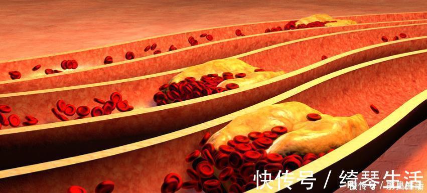 症状|腿部有5症状，可能血脂高了，做好1件事，不出1个月，血脂降了