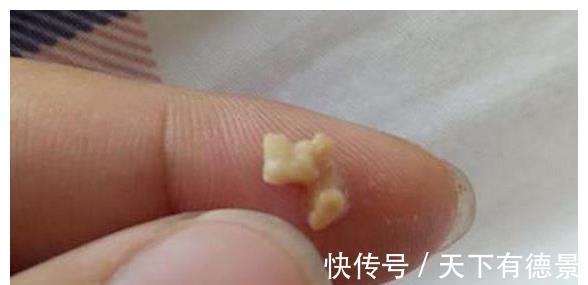 扁桃体结石|孩子因口气臭被同学排挤,送诊查检后,医生都没忍住恶心呕吐