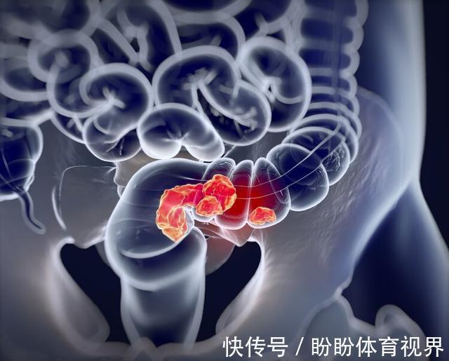 结直肠癌|出现便血,是肠癌还是痔疮?医生教你从三方面辨别,别再混淆了