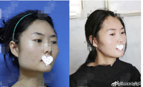 磨截联合长弧线下颌角整形比普通下颌角手术好在哪儿？风险更小吗？