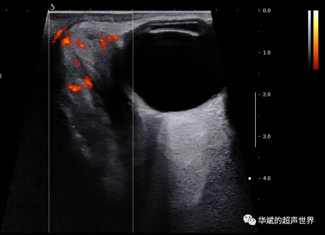 类风湿性关节炎|典型病例?眶内炎性假瘤