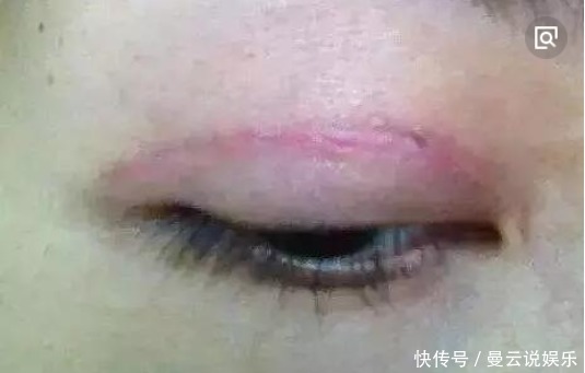 手术割了双眼皮的人,老了之后有什么影响看完真要留意了