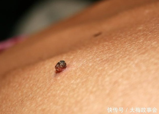 基底细胞癌|只因搓破身上一颗小痣,25岁男子患上癌,这些痣都需要谨慎