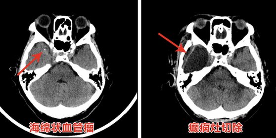 古稀老人|海绵状血管瘤继发癫痫20年 精准外科为古稀老人彻底止“抽”