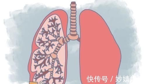 肺结节|如果手部出现这些问题,不是关节炎,或是肺结节发展了,了解一下