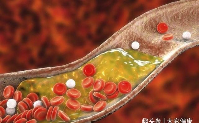 血压升高|高血压不能碰洋葱?医生建议:4种食物不妨常吃,有助平稳血压!