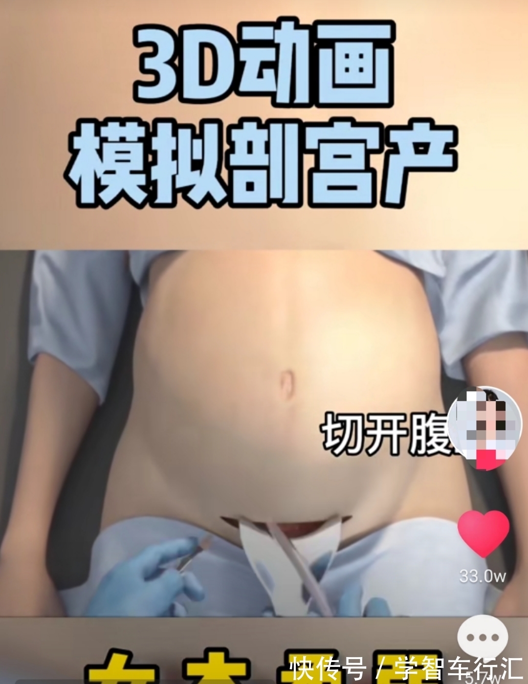 谢楠|剖宫产有多“伤”妈妈,几张3D过程图带你了解,感恩老婆和妈妈