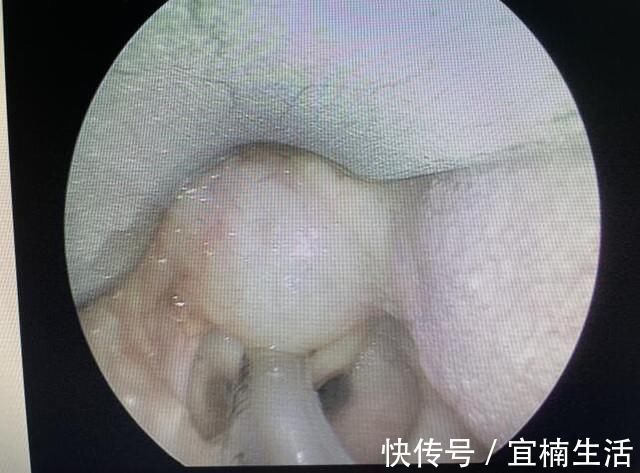 气管插管|真·如鲠在喉!济一2个月小孩嗓子里长了巨大肿瘤