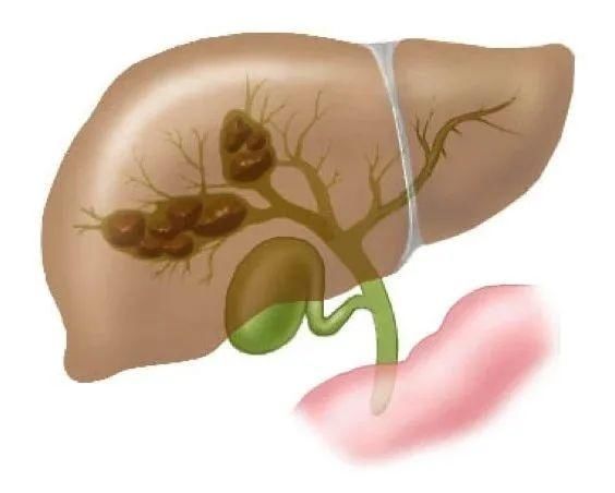 恒生医院|深圳恒生医院利用钬激光碎石术为患者取出数十枚肝内胆管结石