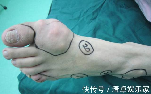 高尿酸|真正的嘌呤王被找到,比猪肉的嘌呤含量高40倍,劝你管住嘴