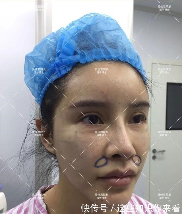 下垂 32岁姑娘小拉皮术后7个半月,变得年轻又精致,前后反差很大!