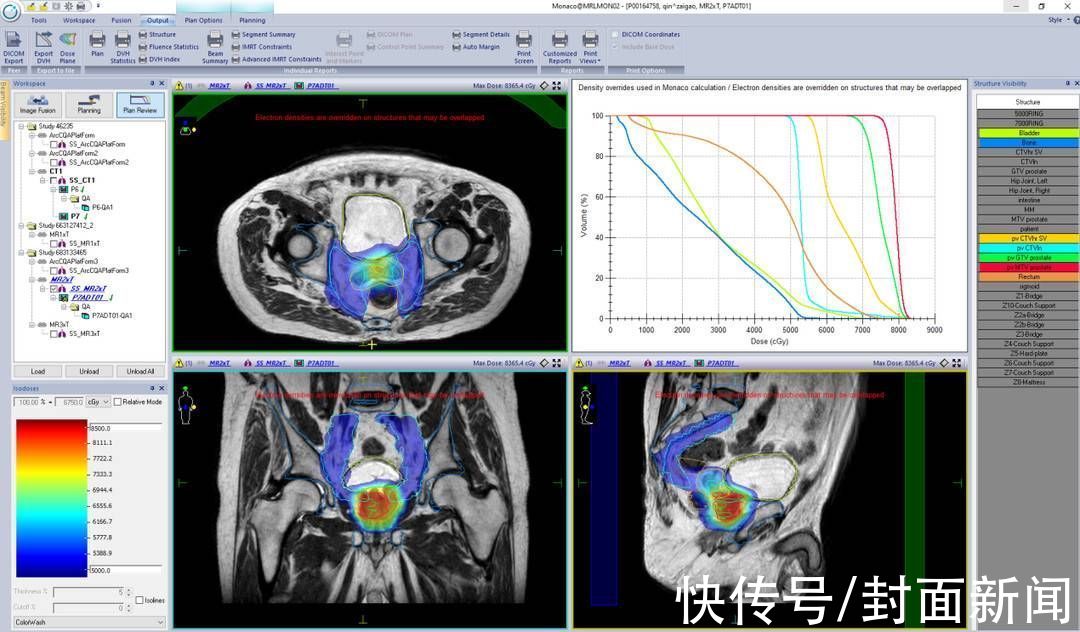 放射治疗|西部地区首台核磁加速器投入临床运行