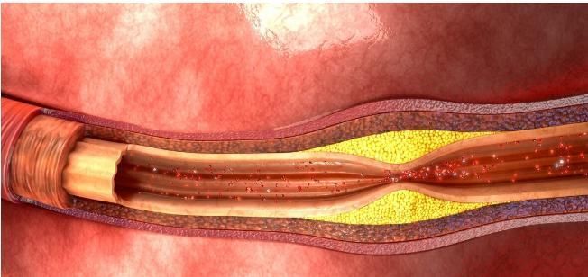 若双腿出现4个迹象,或是在反复提醒你:血脂高