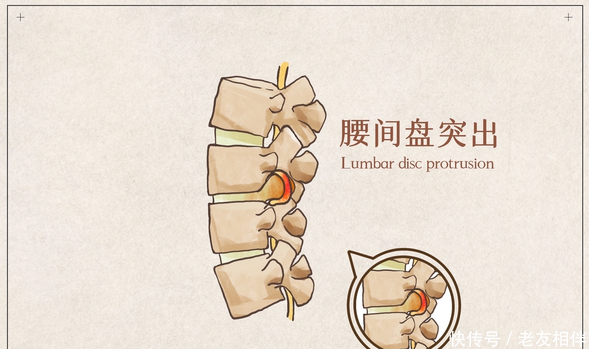 坐骨神经|腰椎间盘突出压迫坐骨神经痛，可以自愈吗？