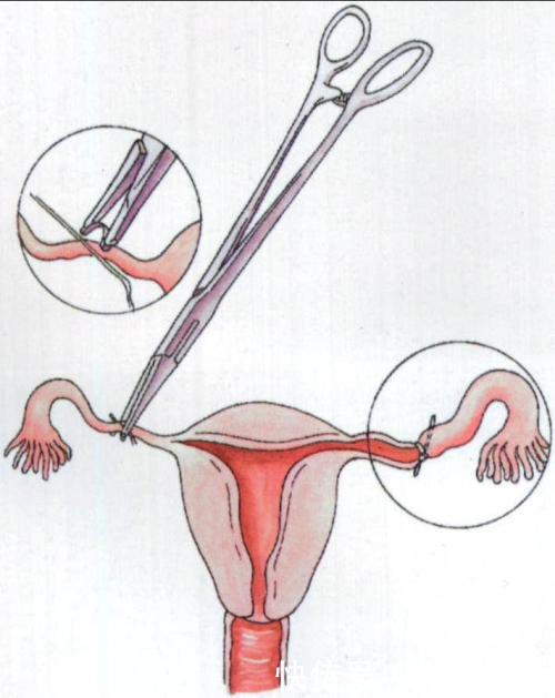 结扎对女性的影响 妇科医生告诉你真相