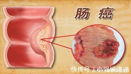 男孩|17岁男孩,一天跑8次厕所,医生分析诱因,一种肉吃太多惹的祸