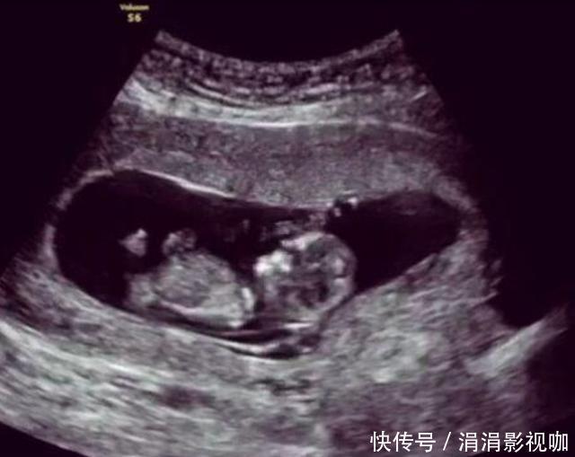 杀手|孕期38周却“胎死腹中”,这些“孕妇杀手”要预防,准爸妈得留意