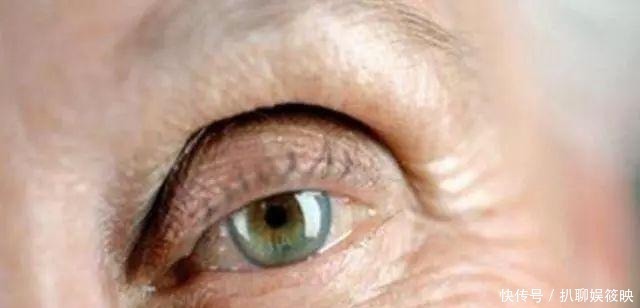 手术|做过双眼皮手术的年轻人,老了以后眼睛会怎么样?看来是这个道理