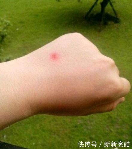 肥皂水|哥哥带着妹妹捅马蜂窝,却被蛰成“猪头”,妈妈迟迟不敢相认