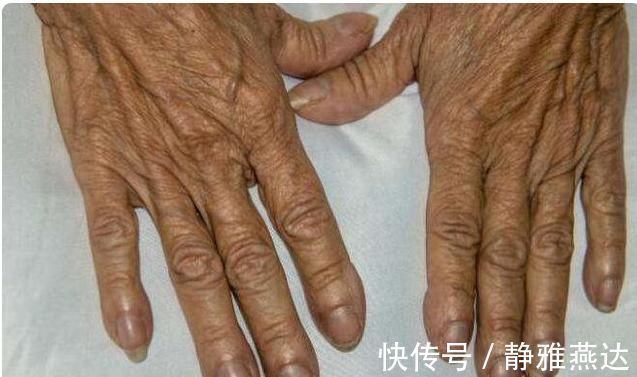 决明子|高血脂人的“福音”被发现,身体出现4种“怪像”,建议查下血脂