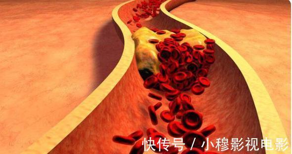 高密度胆固醇|被查出高胆固醇,不想吃药怎么办?分享4点建议,血脂或许会下降