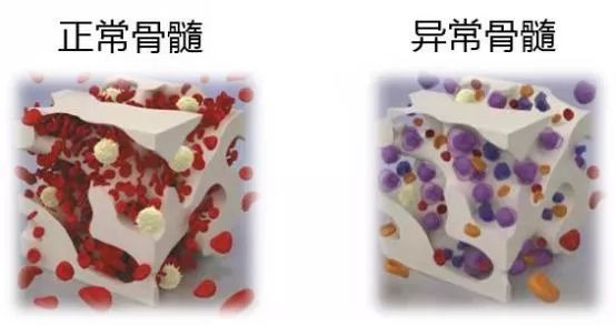 造血干细胞|病态疲乏,当心悄悄发生的骨髓“慢急症”,好发于长期暴露在危险因素下的老年人!