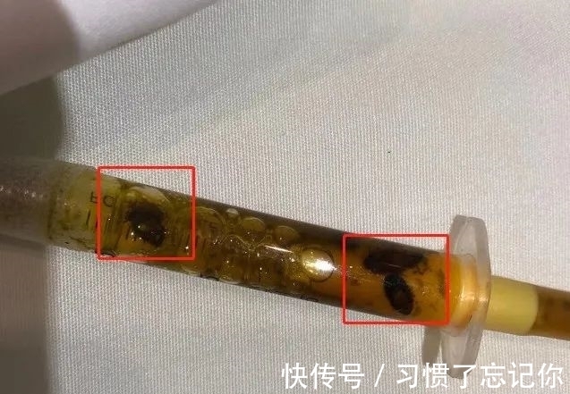 瓜子|头皮发麻！男子体内惊现大量“瓜子”活虫……取出来还在动！
