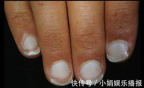 黄甲综合征|身体有问题,指甲告诉你!指甲出现9种变化,恐是疾病来袭
