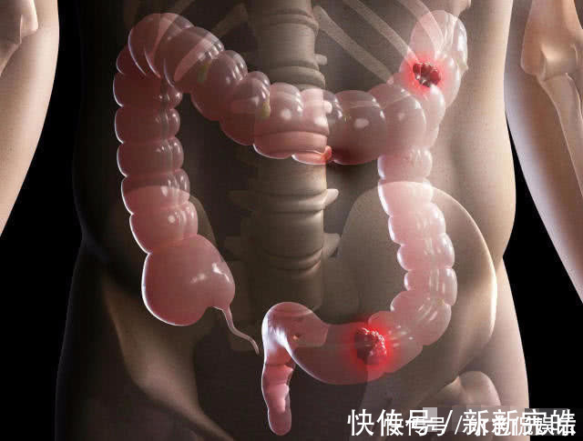 医生|三天大便一次和一天大便三次,哪个危害更大,听了医生说都明白了