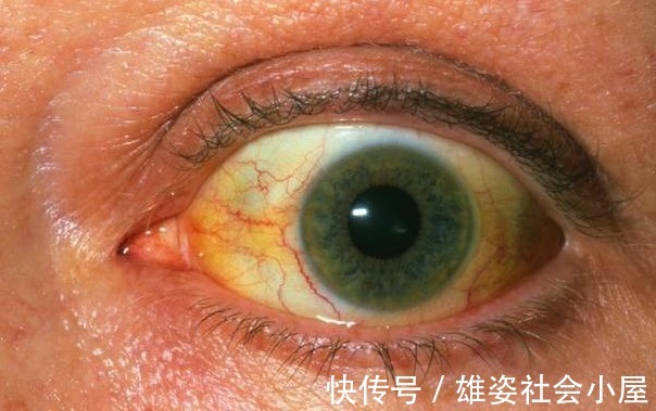 脱发|若头部有这4种迹象，很不幸地告诉你：肝脏已经发出最后的警告了