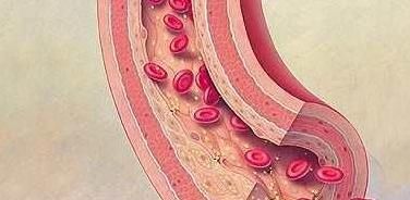 作用|家里有血栓病人,多吃5样常见食物,可帮你清血管,吃的越多越好