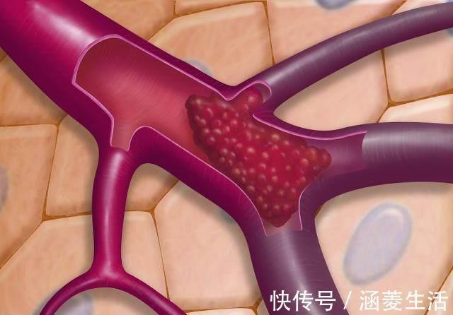 心脏学|脚上有个“化栓开关”，打开它，就可清血管、防血栓