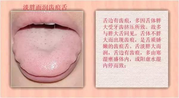 舌诊|中医医生总看舌头都在看什么九种体质+珍贵的舌诊图谱