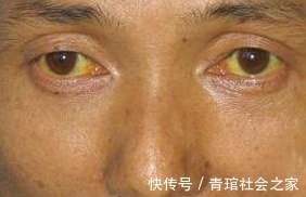 哈喇味|4種食物堪稱“壞肝王”，越吃肝越“虛”，管住嘴，保護你的肝臟