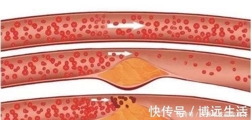 天敌|血栓天敌被发现了,每天吃2口,清血管冲走血栓,杜绝高血脂