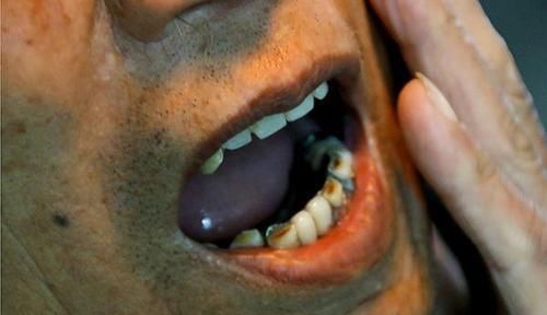 身体|癌症患者在化疗期间，需要注意什么医生牢记3要点，对身体好