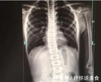 受压|8岁男孩脊椎侧弯,只因家人常做这个动作,这个错误,90%的父母都在犯