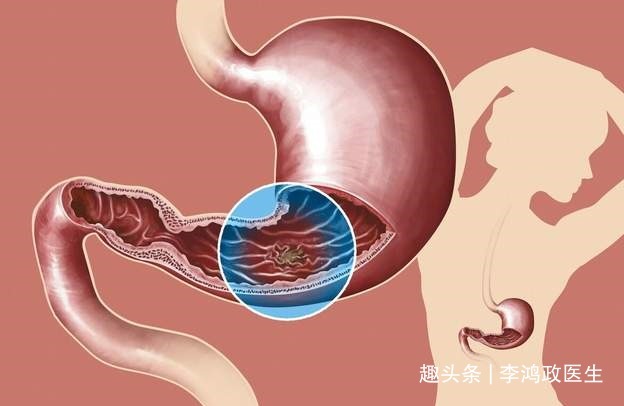 医生|女子头晕半年，以为患癌症，检查结果让她觉得重获新生